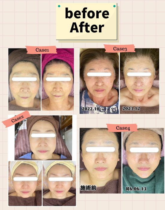 小顔エステビフォーアフター